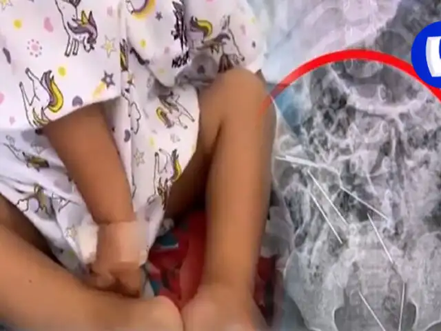 ¡increíble! niño de 2 años tenía ocho agujas en su estómago en Tarapoto
