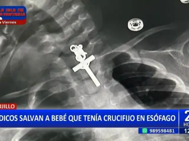 Trujillo: Médicos salvan a bebé de 1o meses que tenía crucifijo alojado en el esófago