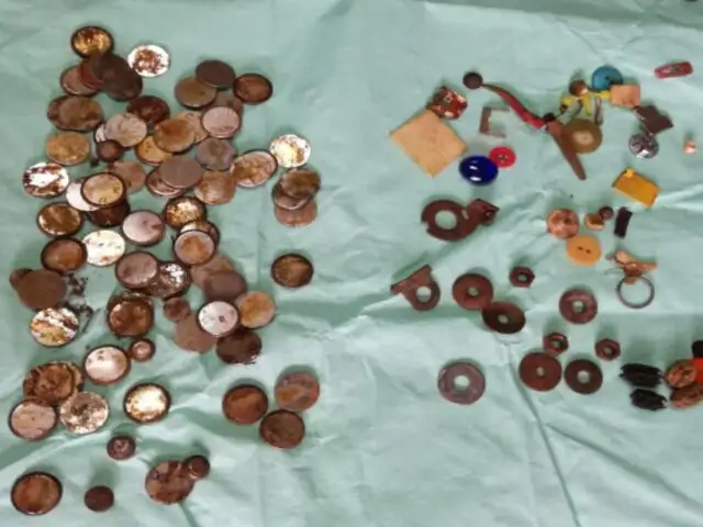 Hospital del Niño: monedas, clavos y más son los artículos que se han extraído de niños
