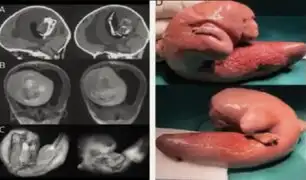Gemelo parásito: la vez que le extrajeron un feto de la cabeza a una bebé de un año