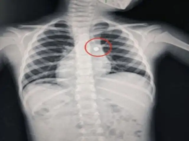 La Libertad: Médicos salvan la vida a niño de 4 años con pila alojada en un pulmón