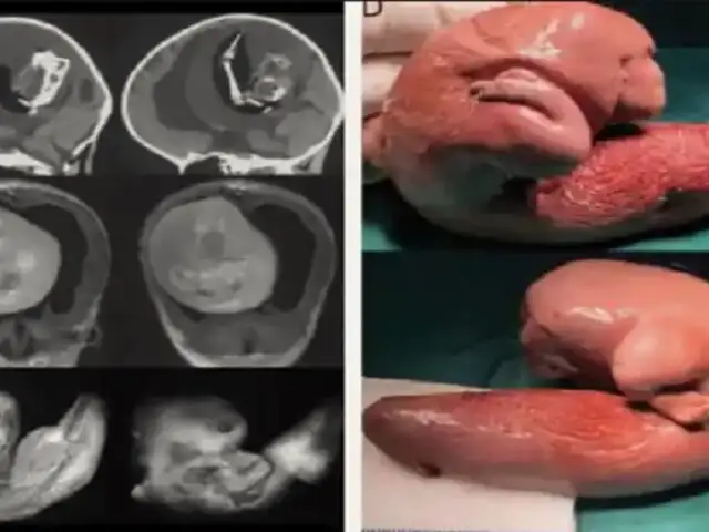 Gemelo parásito: la vez que le extrajeron un feto de la cabeza a una bebé de un año