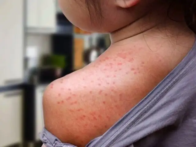 Joven de 22 años sufre rara enfermedad: Es alérgica al agua y no puede bañarse