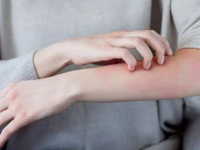 ¿Qué enfermedades de la piel empeoran con el frío y cómo prevenirlas?