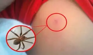 Alerta en casa: ¿Mordedura de araña? conoce qué hacer y qué evitar