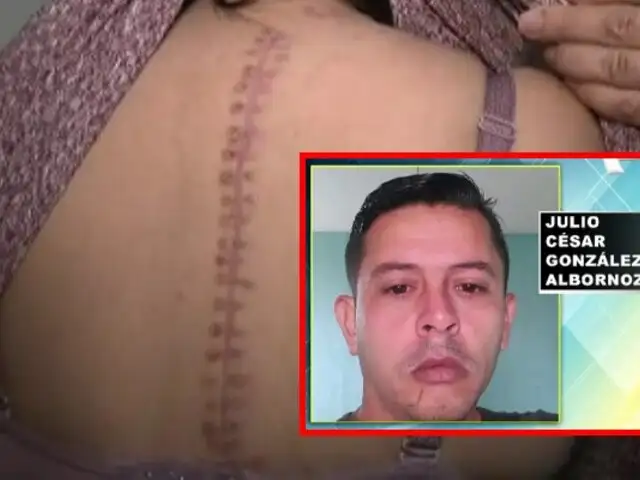 Mujer acuchillada por su expareja tiene 100 puntos en todo el cuerpo: agresor está libre y víctima teme por su vida