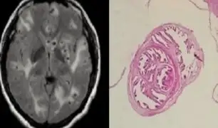 Sus migrañas ocultaban algo más grave: hombre desarrolla gusanos en el cerebro por consumir tocino mal cocinado