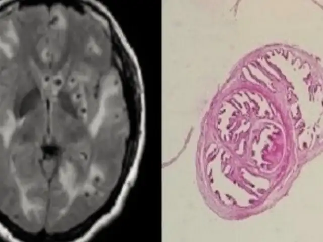 Sus migrañas ocultaban algo más grave: hombre desarrolla gusanos en el cerebro por consumir tocino mal cocinado