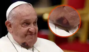 El papa Francisco sufrió un golpe en el rostro por esta razón