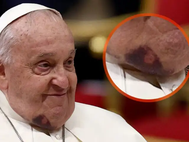 El papa Francisco sufrió un golpe en el rostro por esta razón