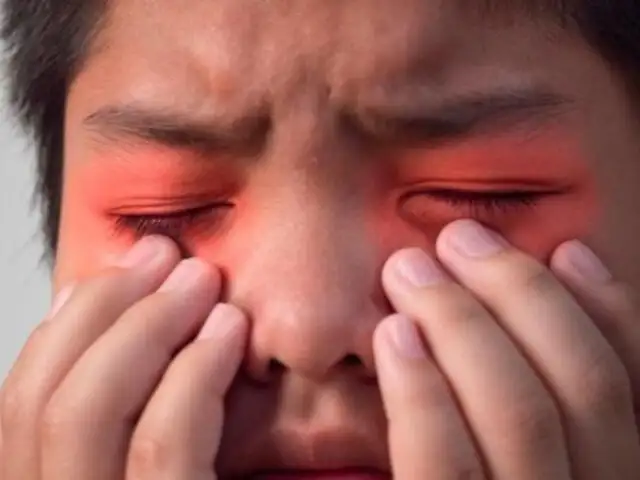 Advierten que frotarse los ojos puede causar irritación, infecciones y daños a la córnea